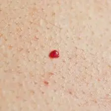Cherry spots