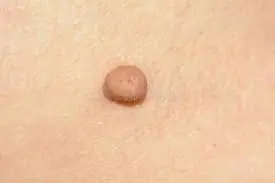Fibrom