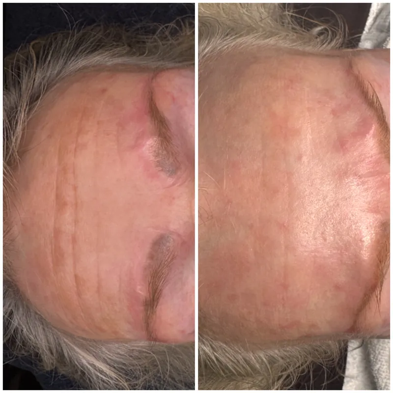 Panna före och efter Cosmo Peel TCA 18% hos Your Skin Clinic i Stockholm