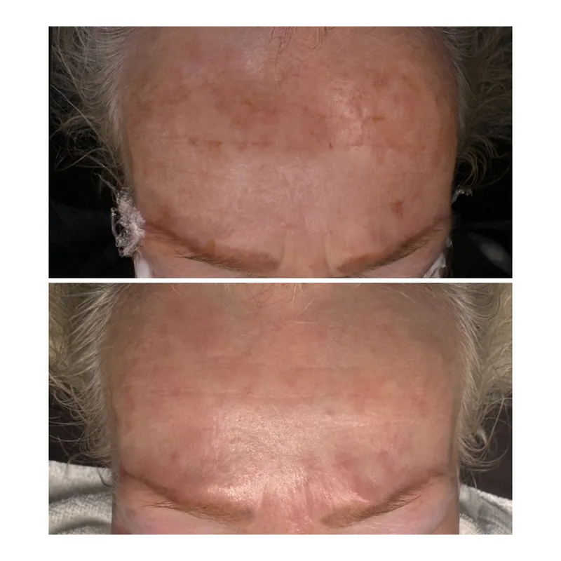 Pannans hudstruktur före och efter Cosmo Peel TCA 18% hos Your Skin Clinic i Stockholm