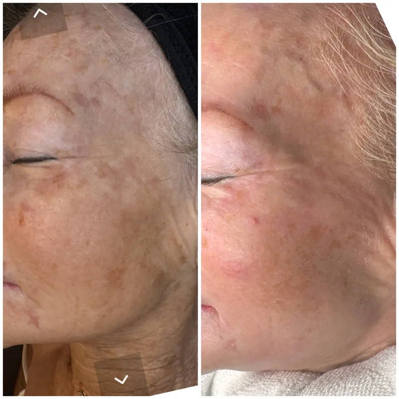 Kind före och efter Cosmo Peel TCA 18% hos Your Skin Clinic i Stockholm