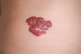 Hemangiom