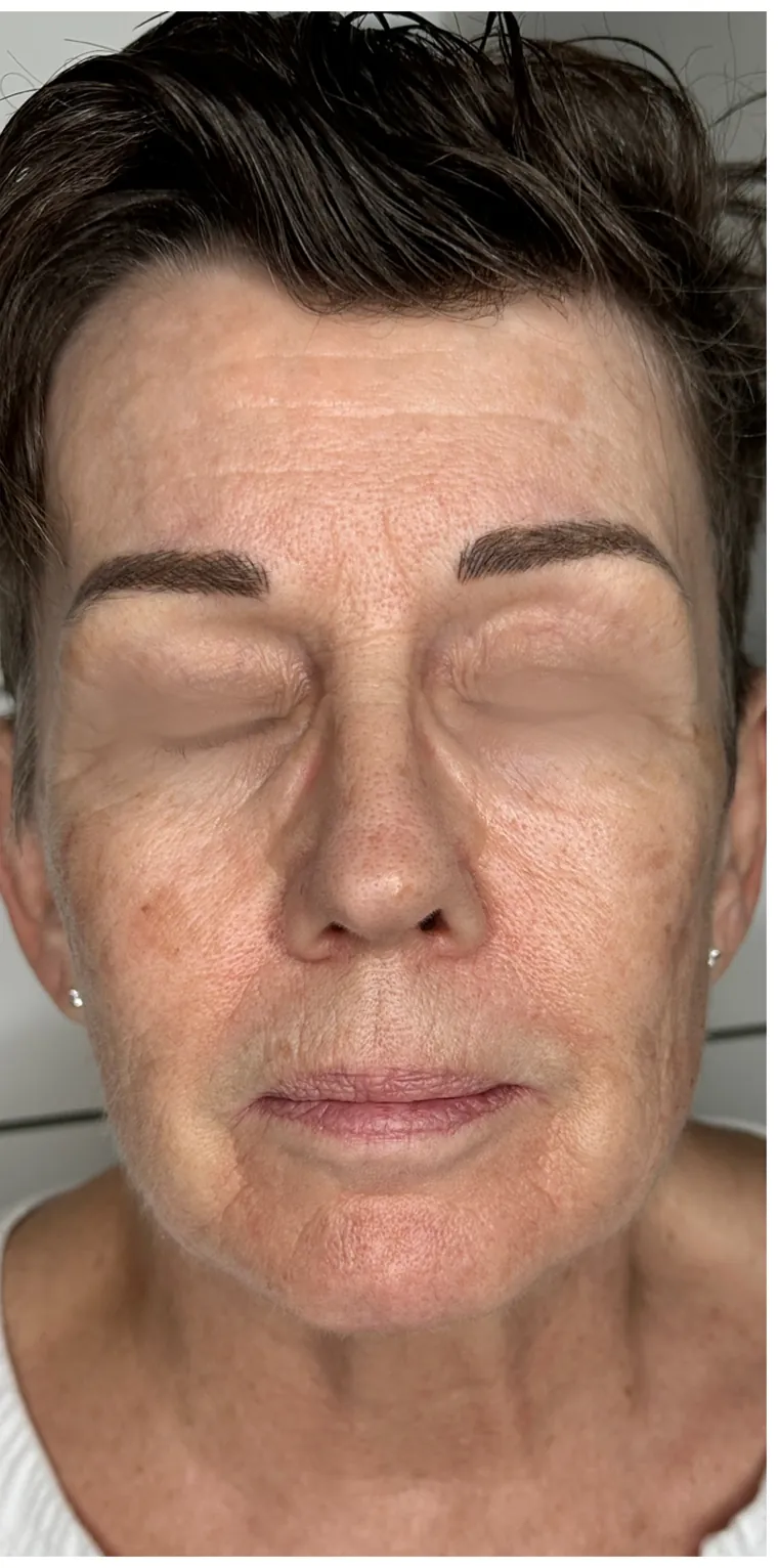 Microneedling efter fyra behandlingar – kundresultat