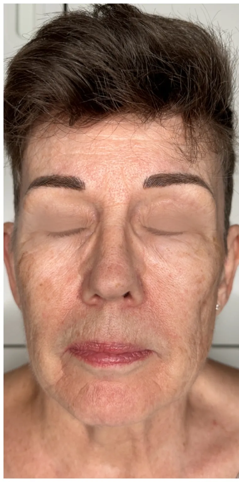 Microneedling före behandling – kundresultat