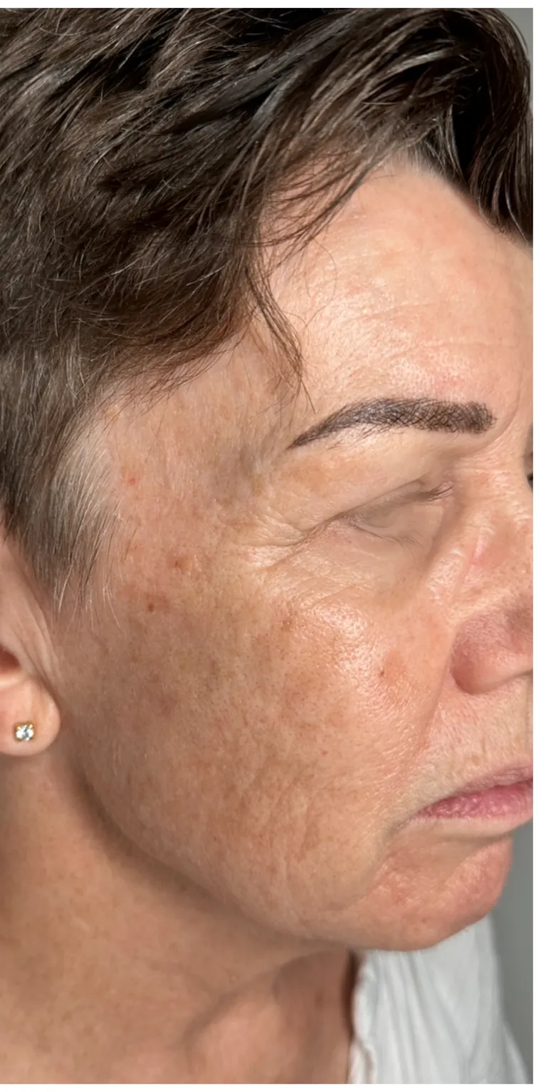 Microneedling efter fyra behandlingar – kundresultat