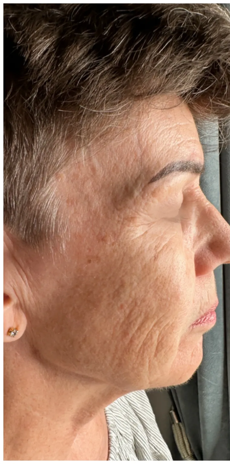 Microneedling före behandling – kundresultat
