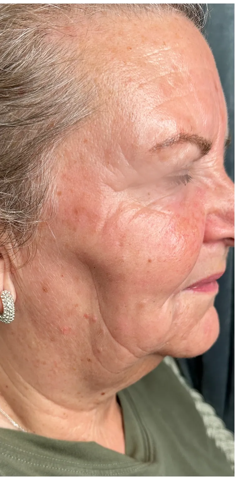 Microneedling efter fyra behandlingar – kundresultat