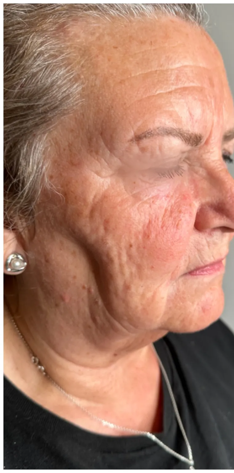 Microneedling före behandling – kundresultat