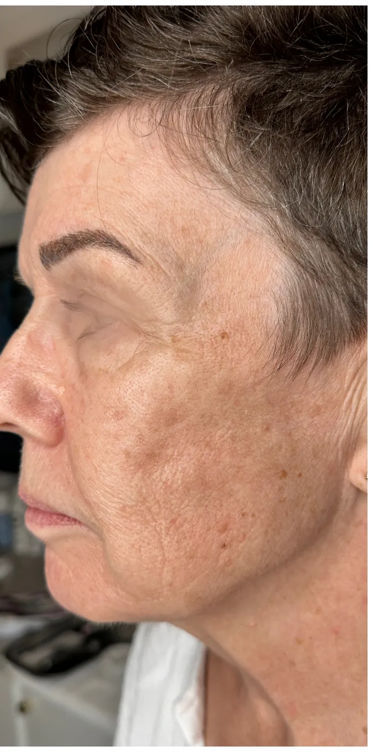 Microneedling efter fyra behandlingar – kundresultat