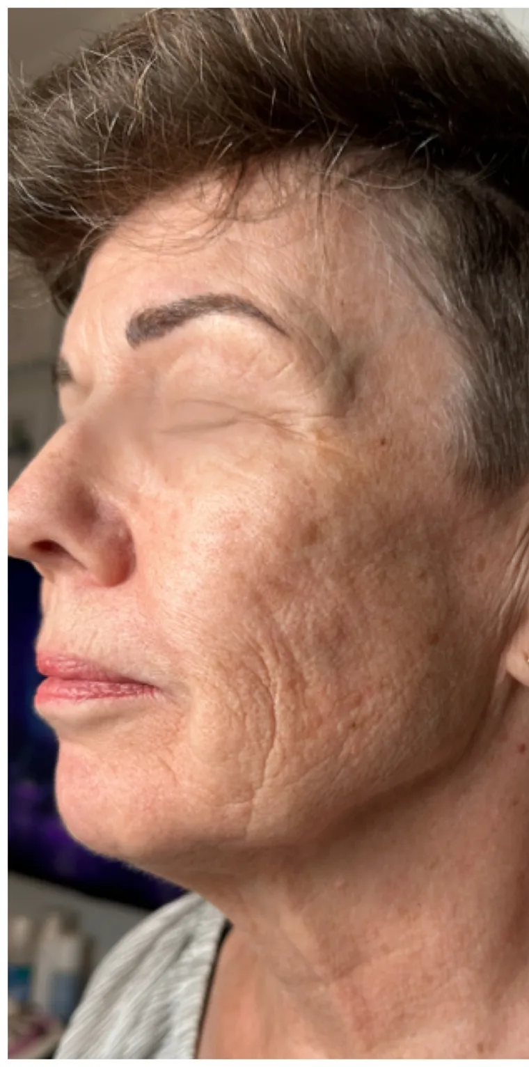 Microneedling före behandling – kundresultat